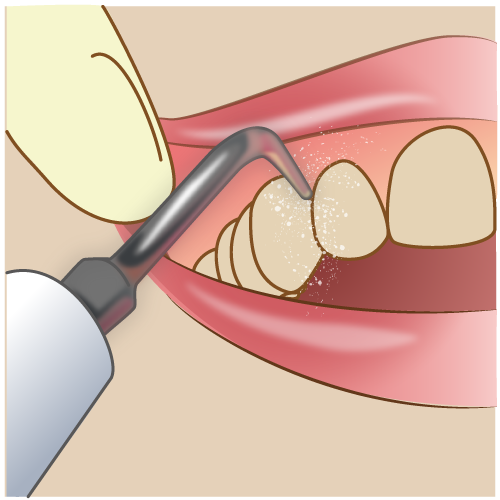 歯周病の治療と予防について